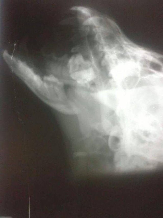 Fractura de mandibula