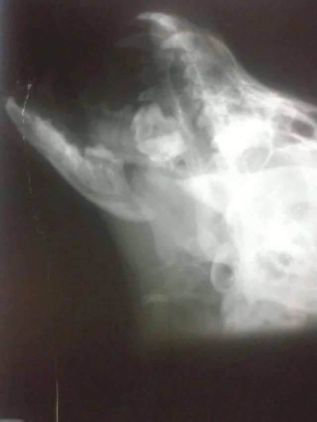 Fractura de mandibula Fractura de mandibula